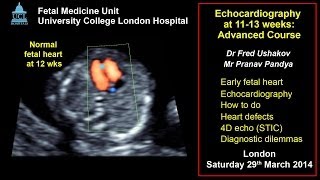 Fetal echocardiography at 1113 weeks ISUOG 2014 advanced course [upl. by Aiak362]