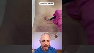 Derm reacts to SUPER ingrown hair dermreacts doctorreacts ingrowmhair [upl. by Deehsar351]