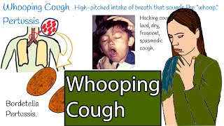 Whooping cough  Pertussis Hacking cough Symptoms and treatment [upl. by Aihtebat]