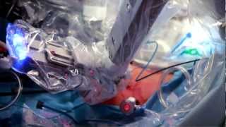 Minimally Invasive DaVinci Robotic Surgery [upl. by Veronike]