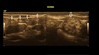 Intestinal Ascariasis  Ultrasound  Case 11 [upl. by Mcdougall]