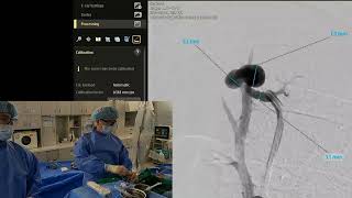 Pulmonary arteriovenous malformation embolization with plugs and coils 폐동정맥기형색전술 [upl. by Engamrahc]