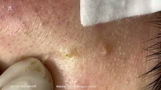 Big Cystic Acne Blackheads Extraction Blackheads amp Milia Whiteheads Removal Pimple Popping [upl. by Alysa385]