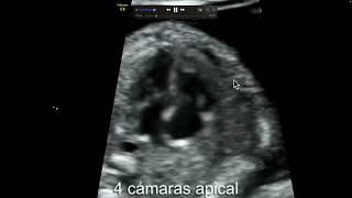 Ecocardiografia fetal Doppler color e insuficiencia tricuspidea Manipulación correcta del PRF [upl. by Katzman467]