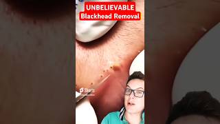 Stunning LIP BLACKHEAD REMOVAL  Biggest Blackheads Ever shorts [upl. by Morie909]