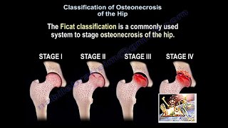 Osteonecrosis Of The Hip Ficat Classification  Everything You Need To Know  Dr Nabil Ebraheim [upl. by Ambrogio]