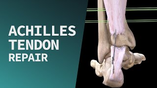 Achilles Tendon Repair [upl. by Gonzalo]