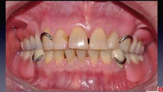 강OOClasp RPD Mxtooth modification Mnsurveyed crown [upl. by Enyawad]