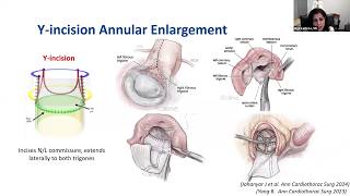 STS Webinar The Future of SAVR August 8 2024 [upl. by Bethany]