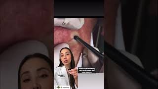 Duet with Dr Pimple Popper Blackhead extraction [upl. by Millham]