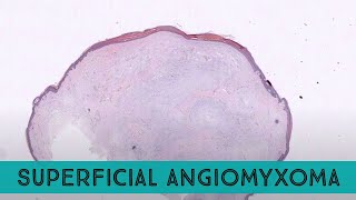 Superficial angiomyxoma cutaneous myxoma pathology dermpath dermatology dermatopathology [upl. by Aihsined]