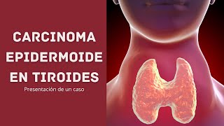 Carcinoma epidermoide en tiroides Caso clínico [upl. by Ahsian]