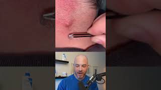 Derm reacts to infected ingrown hair dermreacts doctorreacts ingrownhair [upl. by Eelamme]