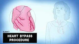 Heart bypass procedure [upl. by Shandy]