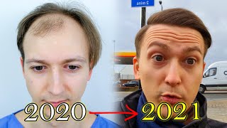 FUE Hair Transplant Growth Timeline  Before amp After [upl. by Haleigh82]