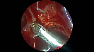 Anterior ethmoidal artery leak by prof dr jaskaran singh [upl. by Afinom]