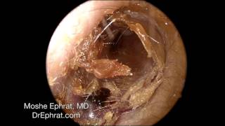 Ear Wax Removal [upl. by Rolan]