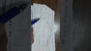 ECG MANY CONCEPTSBASICSIN 1 ECG LEFT ANTERIOR FASCICULAR BLOCK LEFT AXIS DEVIATION [upl. by Ela761]