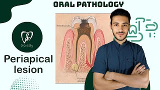 Periapical lesion  oral pathology [upl. by Alletsirhc527]