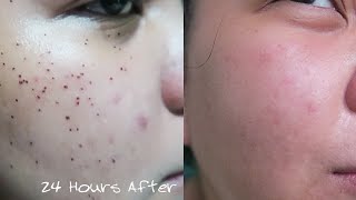 Warts Removal Recovery Diary  August 1 2016  Mommy Roxi [upl. by Narcho]