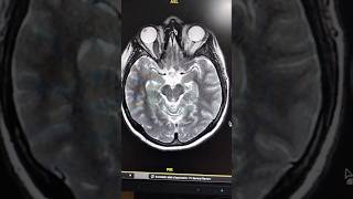 Optic Nerve Glioma [upl. by Judus]