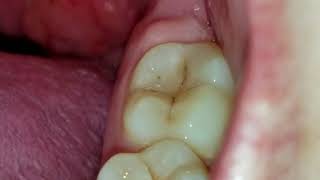 Tonsil stone removal BLOODY WARNING GRAPHIC CONTENT IN VIDEO [upl. by Larena]