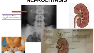 FISIOPATOLOGÍA URINARIA Litiasis renal o nefrolitiasis piedras en el riñón [upl. by Ellevel]