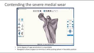 Exactech GPS Preoperative Planning Examples [upl. by Gunner]