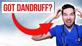 How to get rid of dandruff permanently at home and treatment [upl. by Ong]