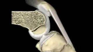 Patellofemoral joint motion and patellar tracking [upl. by Notgnimer927]