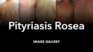 Pityriasis Rosea Image Gallery [upl. by Oinotnaesoj862]