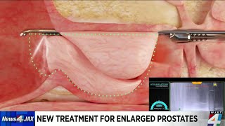 New treatment for enlarged prostates [upl. by Niddala]