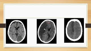 Cerebral Venous Sinus Thrombosis by Dr Zaheer Ahmad Prof Ahmed Bilal [upl. by Ahsille]