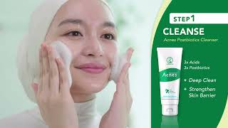 Acnes 3 Simple Steps to AcneFree Skin [upl. by Ritch]