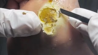 Pedicure video24，vertical plantaris，plantar wart [upl. by Ailic]