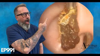 HOW TO SAFELY REMOVE A HUGE EAR WAX PLUG Earwax removal  EP991 [upl. by Johnette]