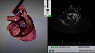 HeartWorks Mechanical Aortic Valve [upl. by Ana]