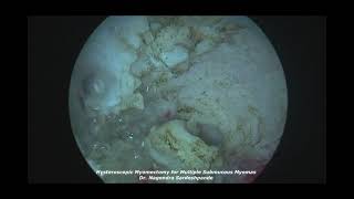 Hysteroscopic myomectomy for multiple submucous myomas [upl. by Cecilio393]