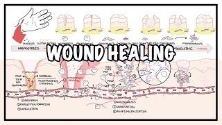 Wound Healing  Stages of healing and pathology [upl. by Brine]