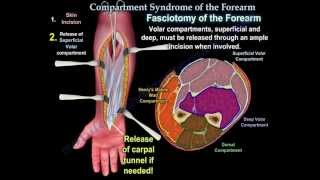 Compartment Syndrome Of The Forearm  Everything You Need To Know  Dr Nabil Ebraheim [upl. by Leind]