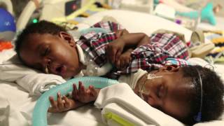 Conjoined twins turn oneyear old [upl. by Eural]