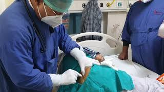 Bone Marrow Aspiration and Biopsy Dr Sandeep Kumar garg Nutema Hospital [upl. by Ban]