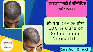 Seborrhoeic Dermatitis For 5 Years Got 100  Cured with Homeopathy [upl. by Neved]