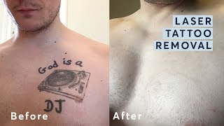 Laser Tattoo Removal  Before and After through all the stages [upl. by Caylor]