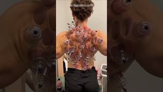 Cupping Therapy explained shorts youtubeshorts [upl. by D'Arcy]