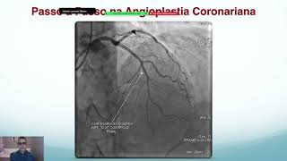 CARDIOLOGIA INTERVENCIONISTA 2024  PASSO A PASSO DA ANGIOPLASTIA CORONARIANA [upl. by Latsryc]