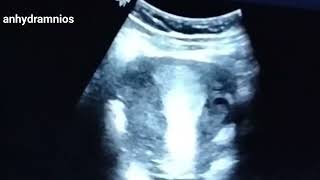 Ultrasound of a live baby with anhydramnios [upl. by Stratton]