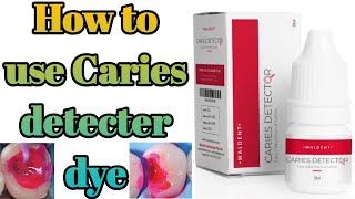 How to use Caries detecter dyeDental bharat [upl. by Eilyr]