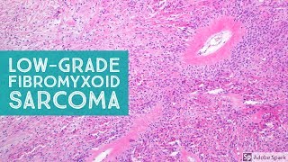 LowGrade Fibromyxoid Sarcoma Evans Tumor 101Explained by a Sarcoma Pathologist [upl. by Garrick]