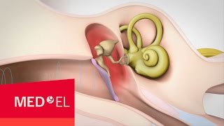 Conductive Hearing Loss Explained  MEDEL [upl. by Hammock]